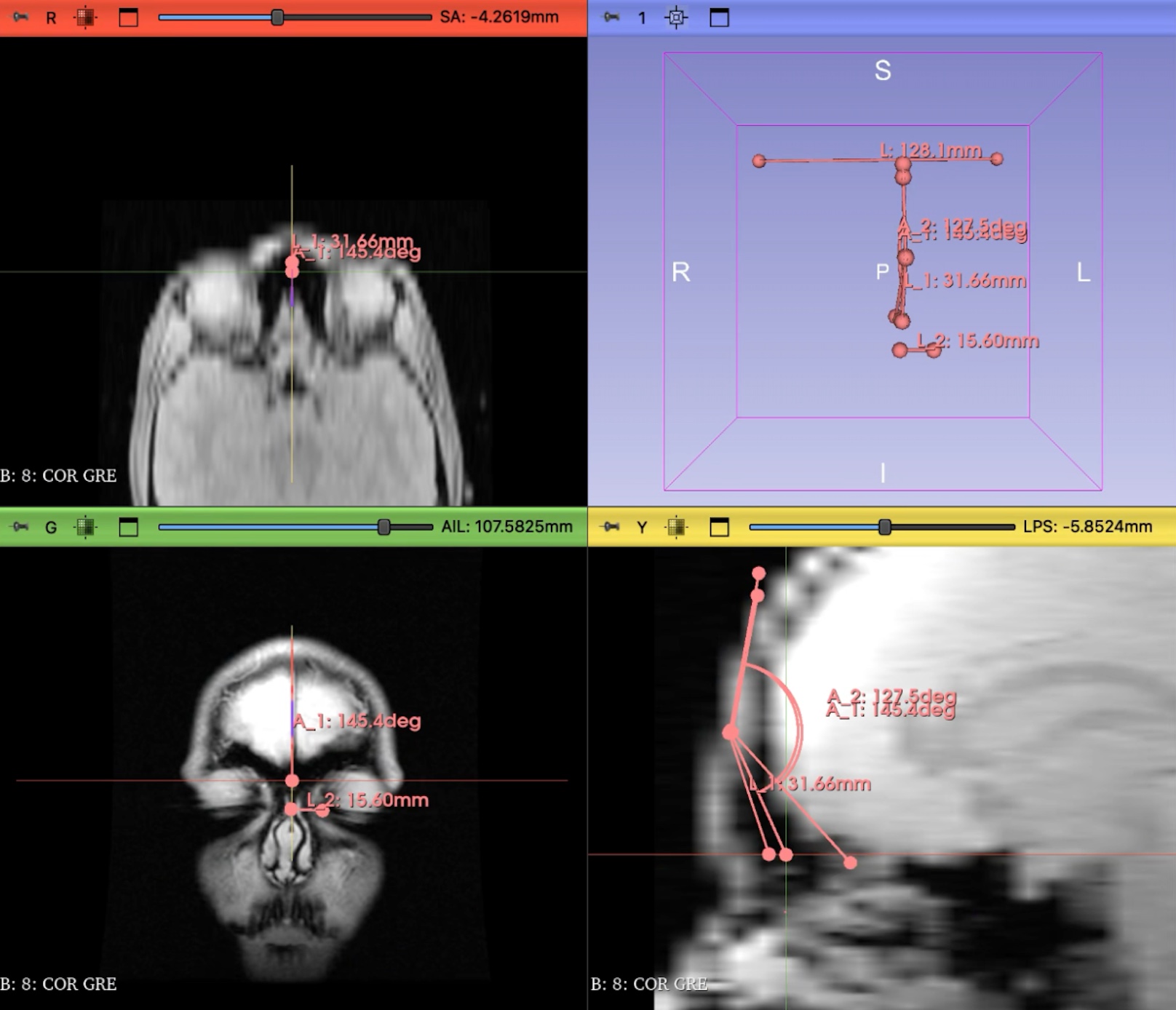 MRI scan showing focal region
